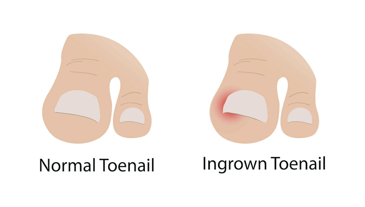 Types of Toenail Fungus: Symptoms, Causes, Treatments