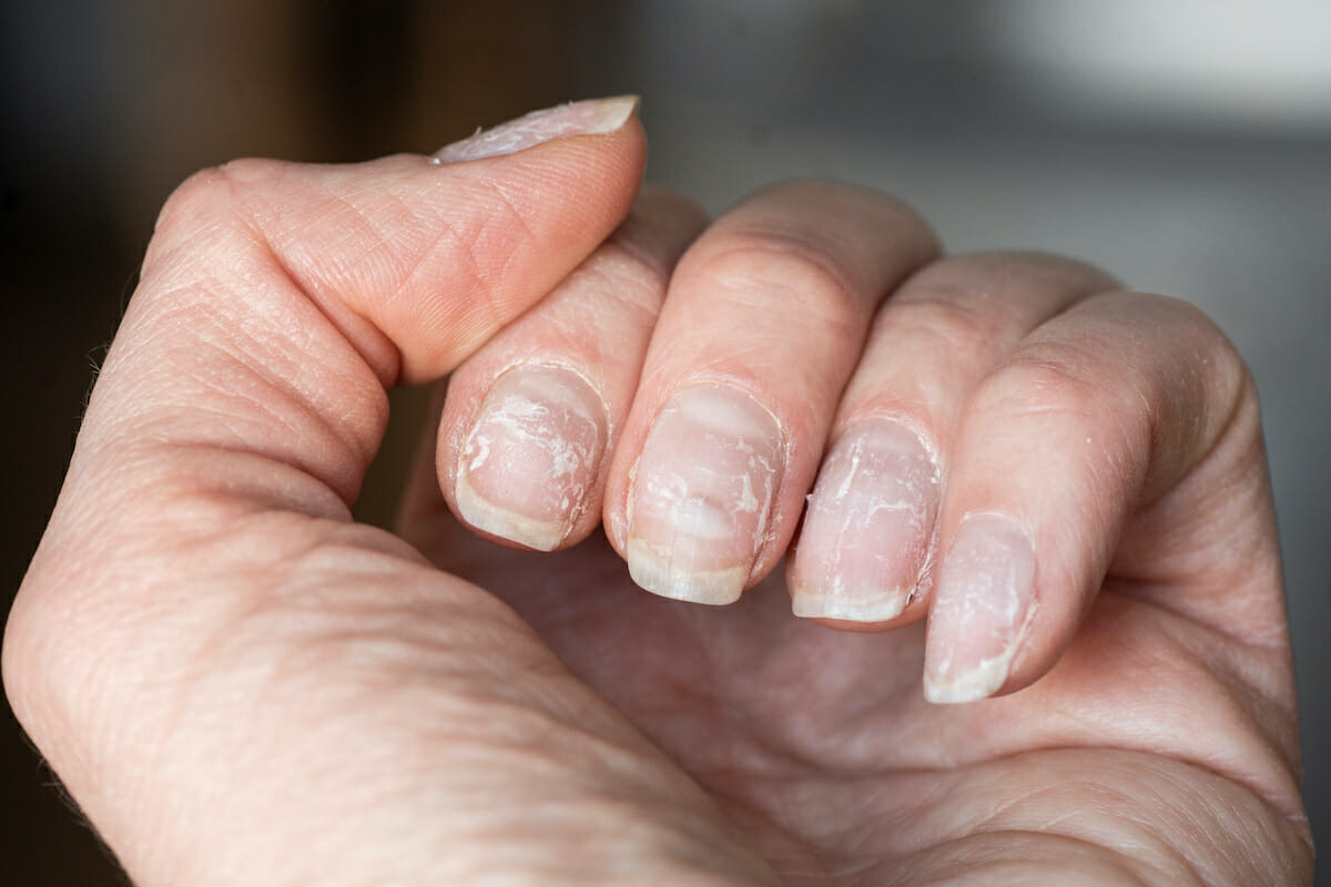 Your Nails Help Diagnose Nutrient Deficiencies - YouTube