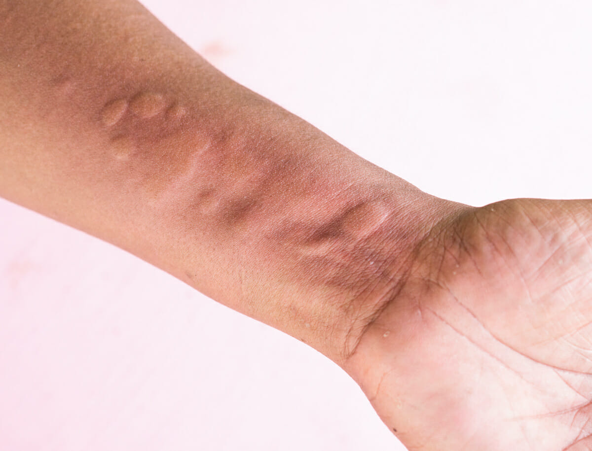 How Long Does It Take For Hives To Stop Itching at Vera Beeler blog