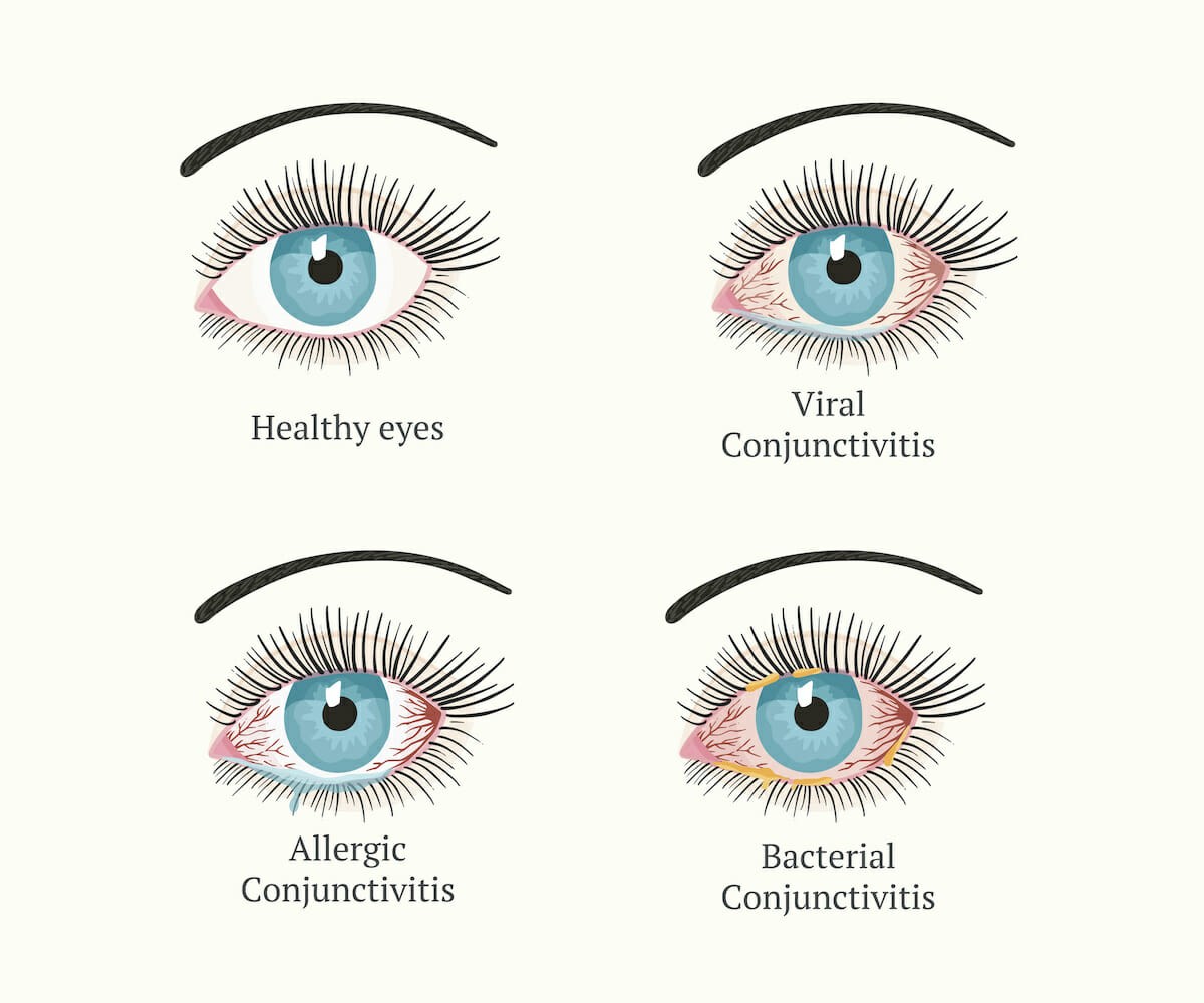 allergic conjunctivitis discharge