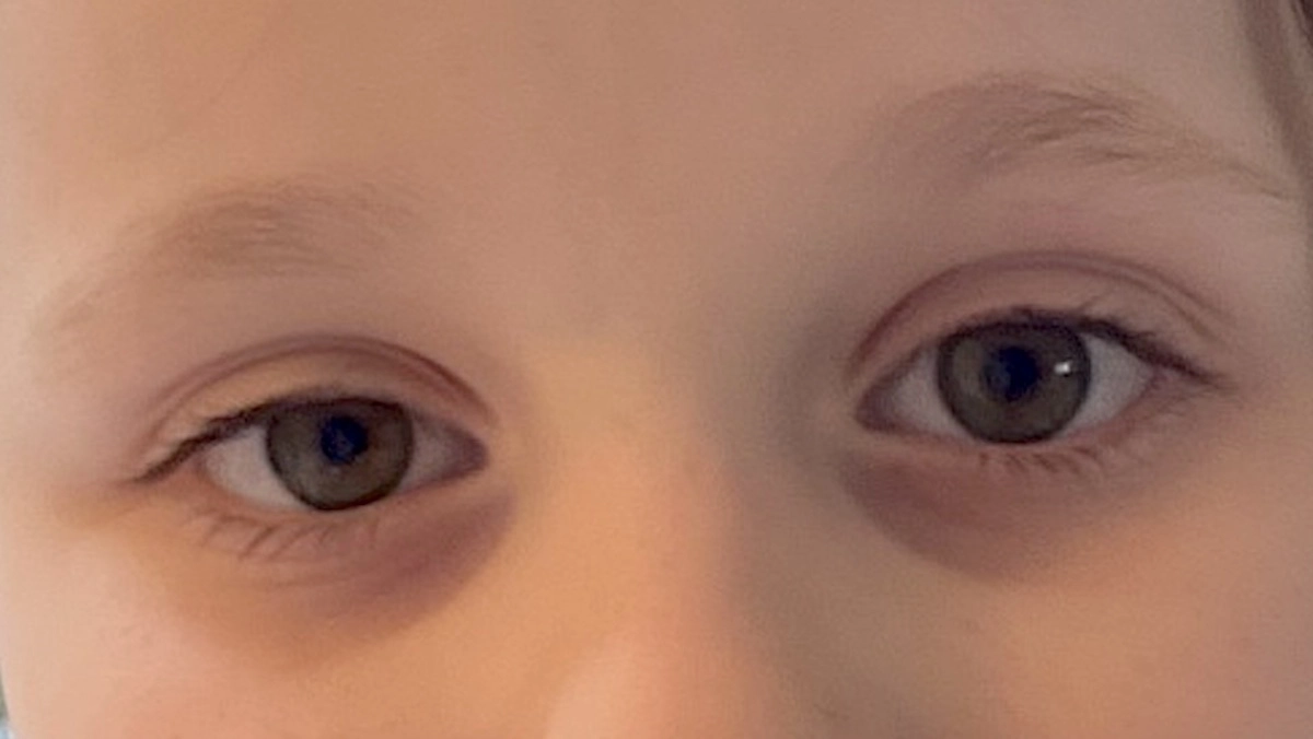 Dark circles under the eyes in kids – The Island News – Beaufort, SC