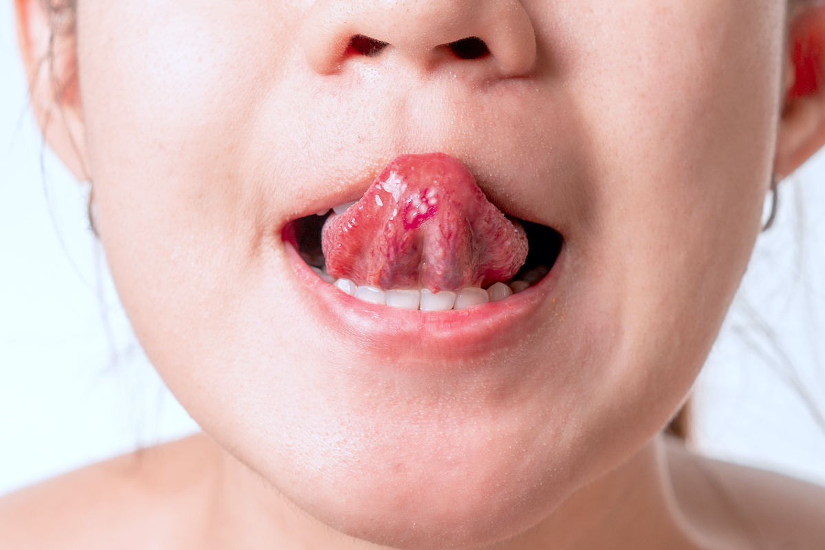 Bumps under your tongue? – The Island News – Beaufort, SC